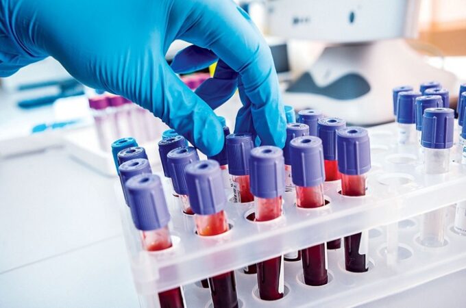 4 Factors To Be Considered Before Opting For Home Collection Of Blood amples