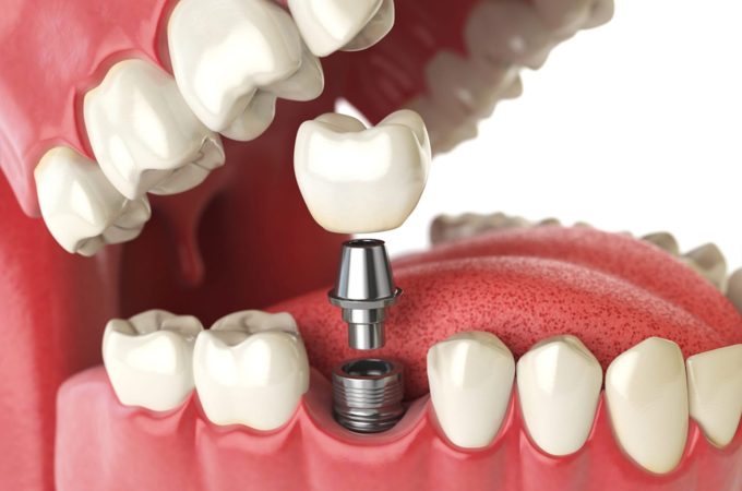 How can dental implants help in easy chewing?