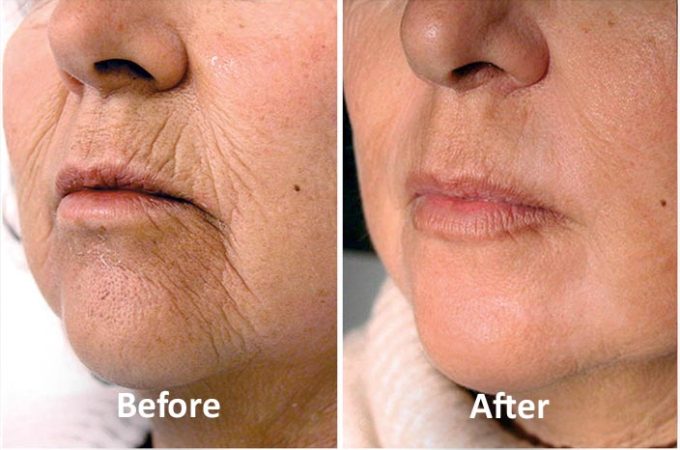Laser skin tightening- Why you need this today and the famous methods. 