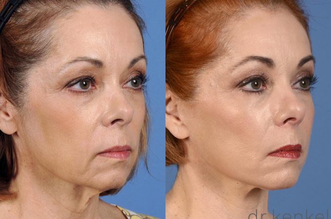 Revamp your Total Look with A Safelift Procedure in Dallas 