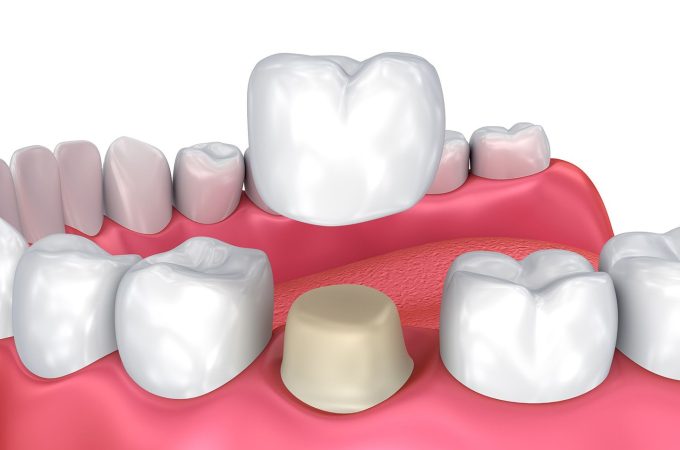 After a Root Canal, Why Do You Need a Dental Crown?