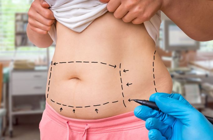 What are the Distinctions Between Liposuction and Weight Loss?
