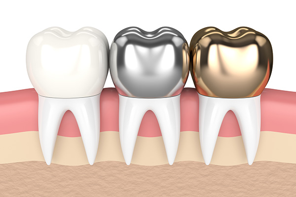 Dental Crowns and its types in Lakeview, Chicago